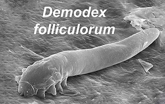 Demodex Mites and Their Connection to Chronic Dry Eye