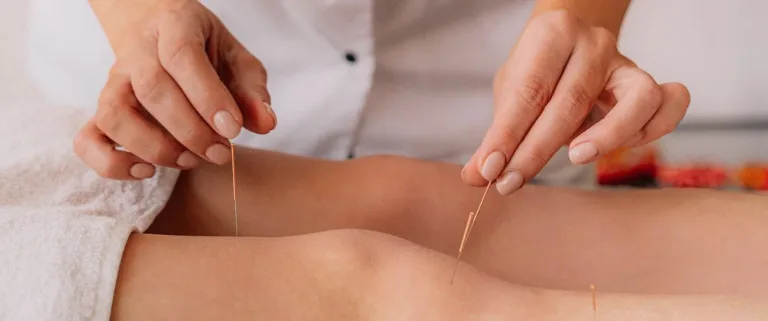 Acupuncture: A Complete Guide to Relieving Stress and Anxiety