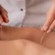 Acupuncture: A Complete Guide to Relieving Stress and Anxiety