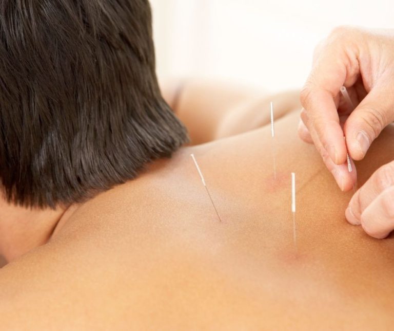 Acupuncture and Cupping Enhance Sports Recovery Efficiency