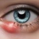 Eye Styes: Causes and Top Home Remedies Uncovered